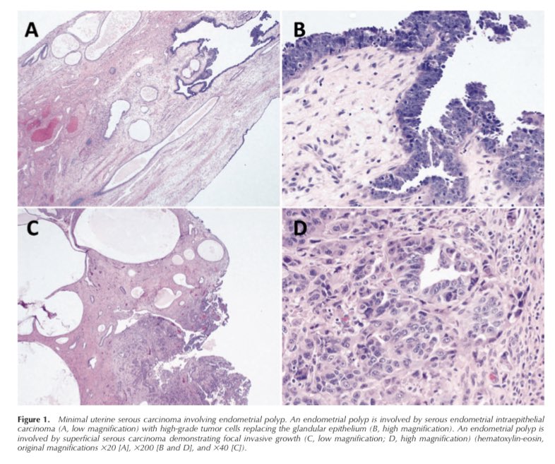 An endometrial polyp in a postmenopausal woman deserves your careful microscopic evaluation. bit.ly/39yKpFt