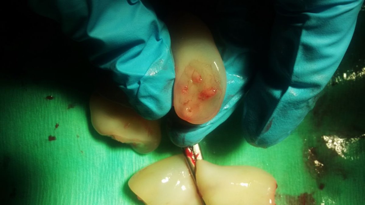 NICU_Musings's tweet photo. You aren't seeing double.  Yes it's a 4 vessel cord secondary to persistence of the right umbilical vein.

Fun fact: Did you know that we all start out with two umbilical veins?!
https://t.co/75TcrWAUmH
#neotwitter #MedStudentTwitter https://t.co/BBfLnNvzft