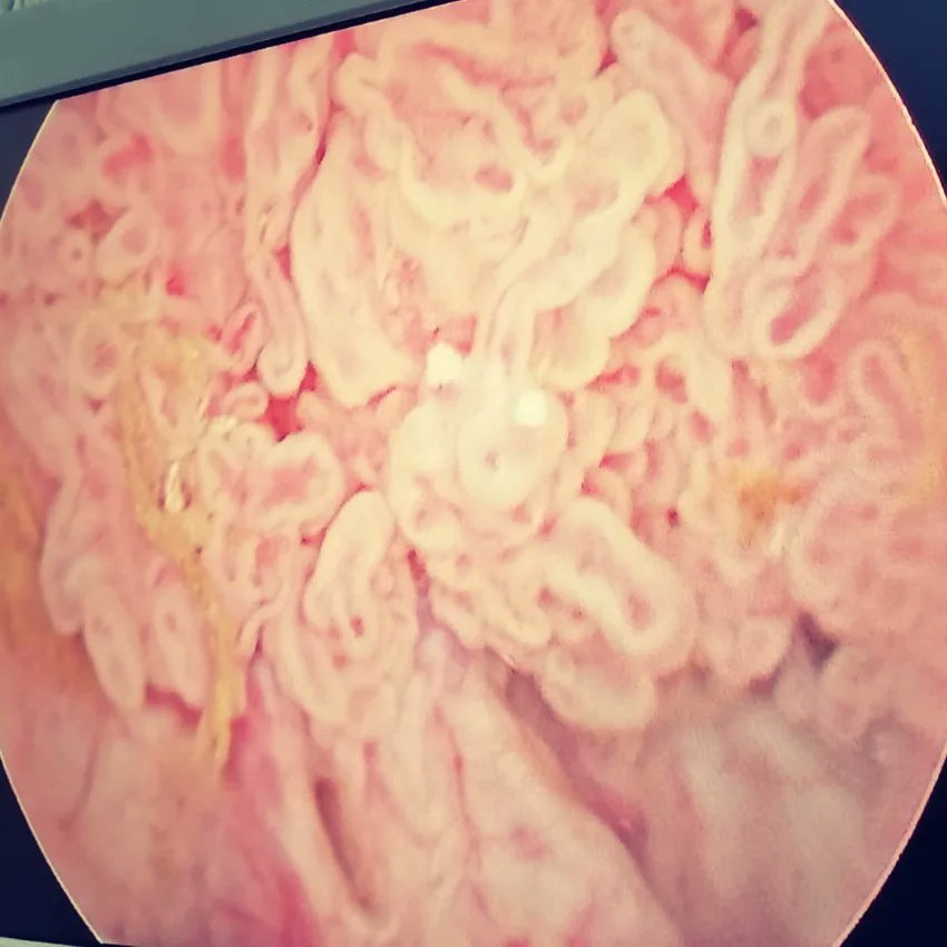 pablinglz's tweet photo. Bladder Tumor TURBT https://t.co/8xUtnVXaeo