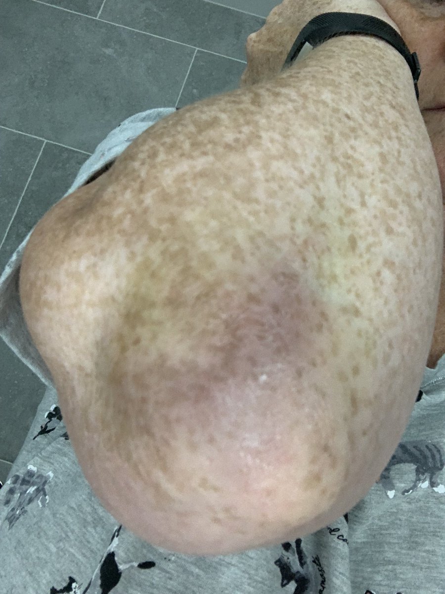 Bentona's tweet photo. @GMB @kategarraway @adilray this is what happened to me last week wearing flip-flops! #flipflopsaredangerous https://t.co/oVaZgXIWpr