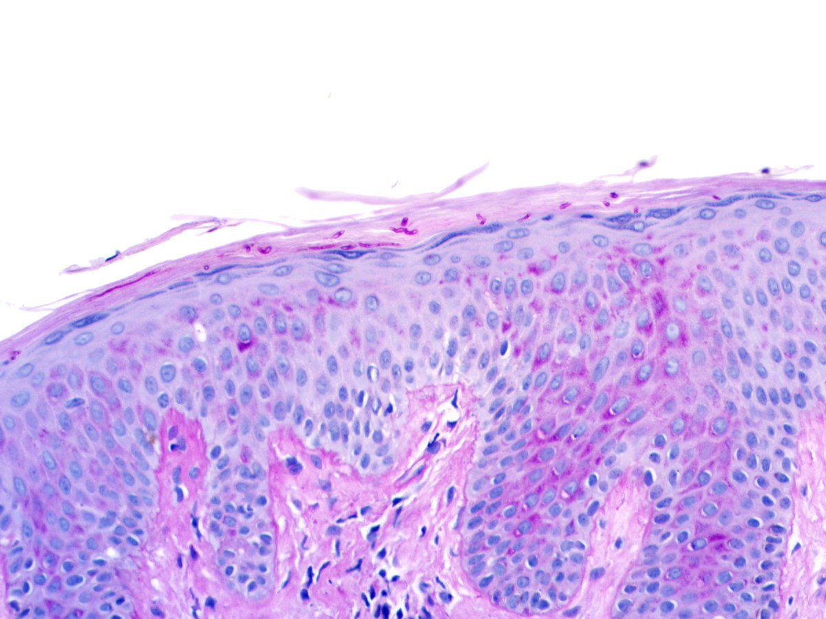 Round “holes” within compact stratum corneum and the corresponding PAS stain 🔬