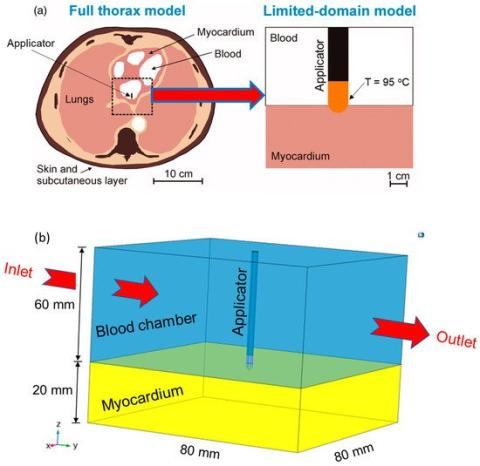 FluidsMdpi's tweet photo. 📚New Publication in #Fluids
📌Read our newly published paper "Three-Phase-Lag #Bio_Heat_Transfer Model of #Cardiac_Ablation"
👔By Dr. Sundeep Singh et al.
#cardiac_ablation
#bio_heat_transfer
#numerical_simulations
👇Read via https://t.co/YookRsZp7m https://t.co/J3GNIjOs8j