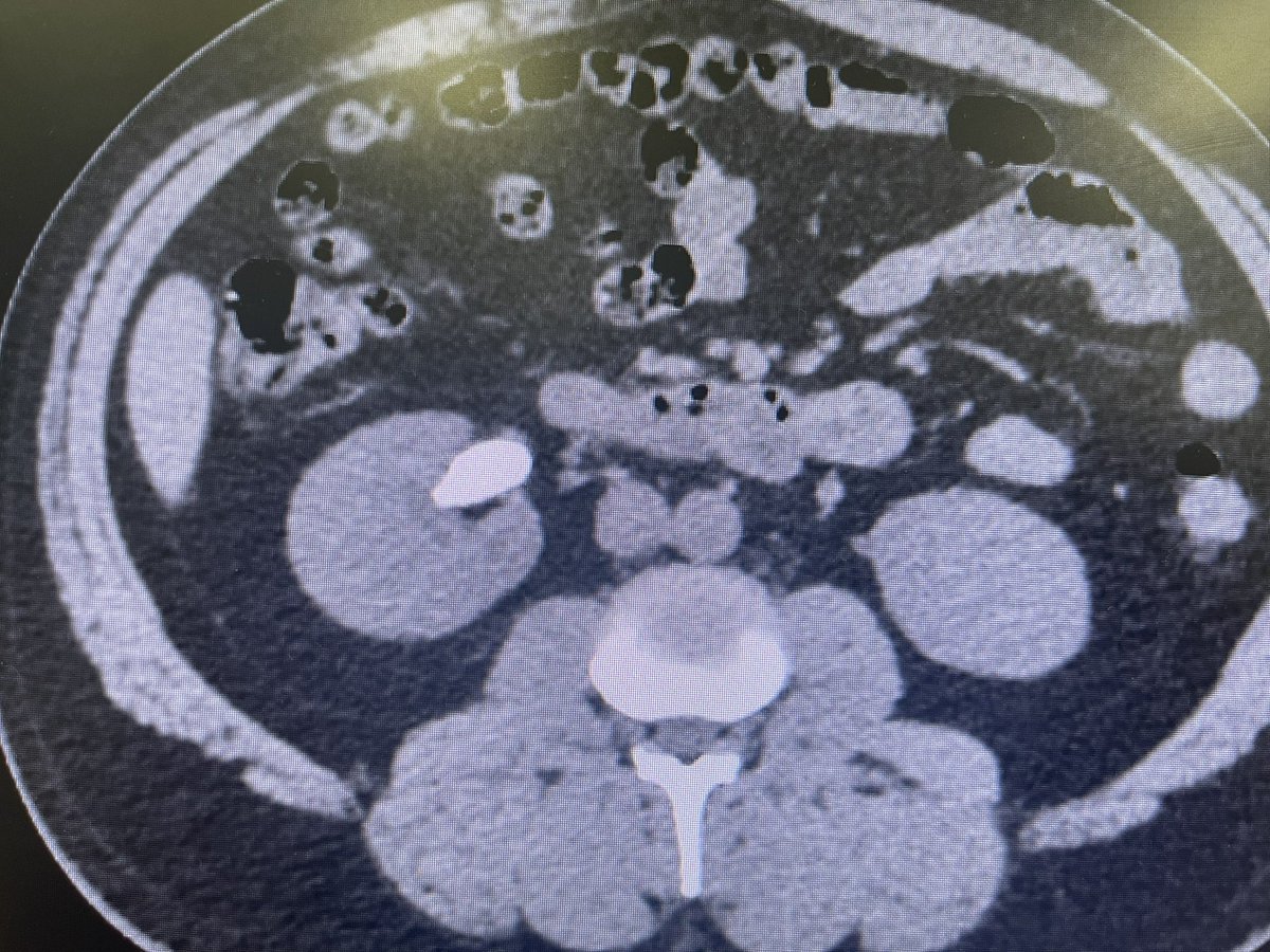 ajcabellog's tweet photo. Tubeless supine #pcnl
#dustingtechnique
#endourology #urology https://t.co/Fz1kIPJCPX