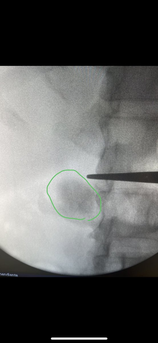 ajcabellog's tweet photo. Tubeless supine #pcnl
#dustingtechnique
#endourology #urology https://t.co/Fz1kIPJCPX