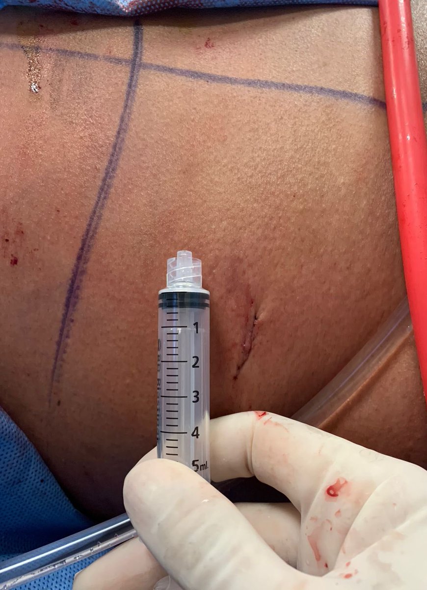 ajcabellog's tweet photo. Tubeless supine #pcnl
#dustingtechnique
#endourology #urology https://t.co/Fz1kIPJCPX