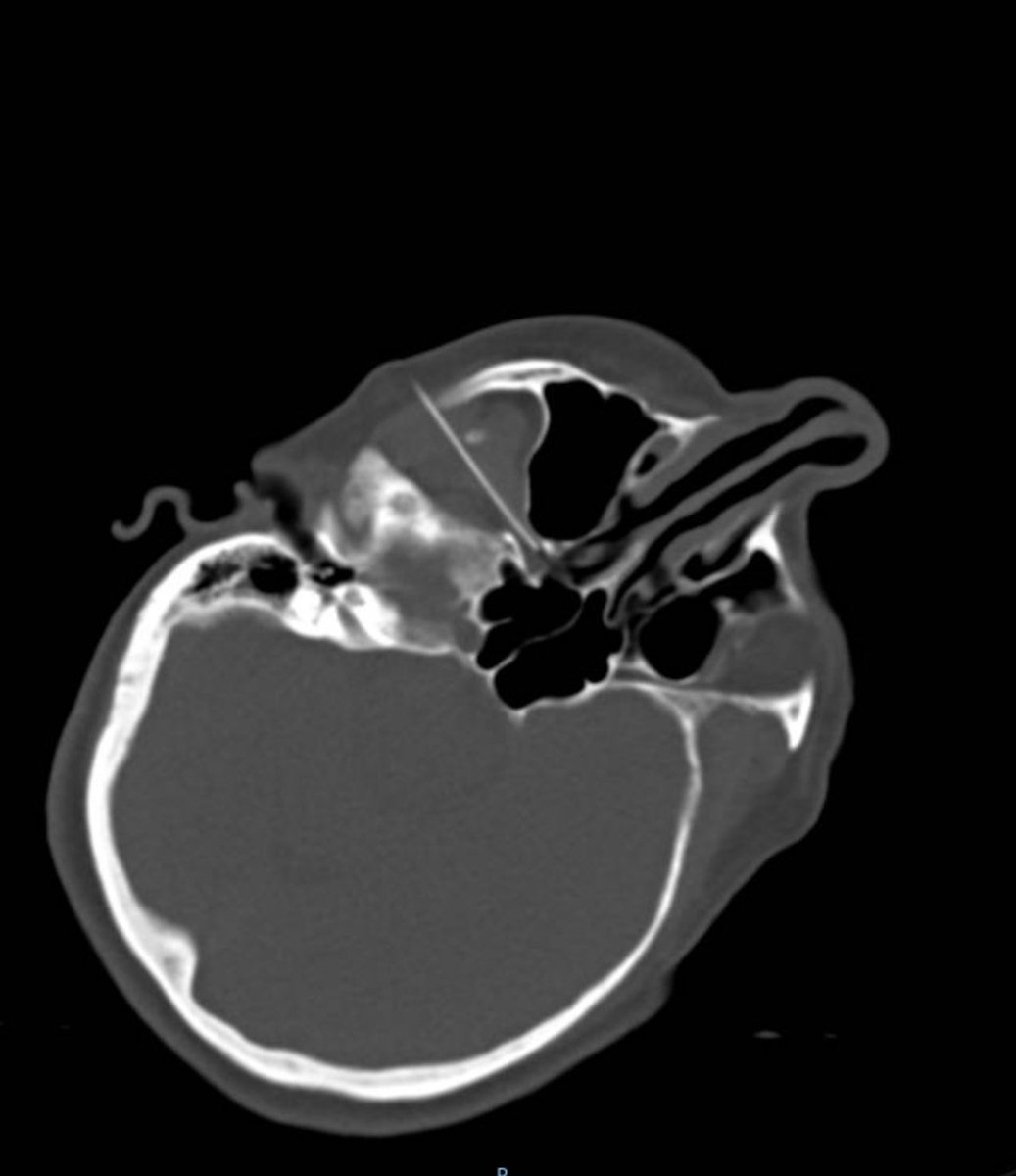 With Cluster Headache, atypical facial pain, trigeminal neuralgia, do not forget sphenopalatine ganglion injection and possible RFA where parasympathetic, sympathetic, and facial sensory crossings are.  <a href="/The_ASSR/">American Society of Spine Radiology (ASSR)</a> <a href="/TheASNR/">The American Society of Neuroradiology</a> <a href="/SIRspecialists/">Society of Interventional Radiology</a> <a href="/SIRRFS/">SIR RFS</a> <a href="/ASPN_PainNeuro/">ASPN</a> <a href="/ASRA_Society/">ASRA Pain Medicine</a>