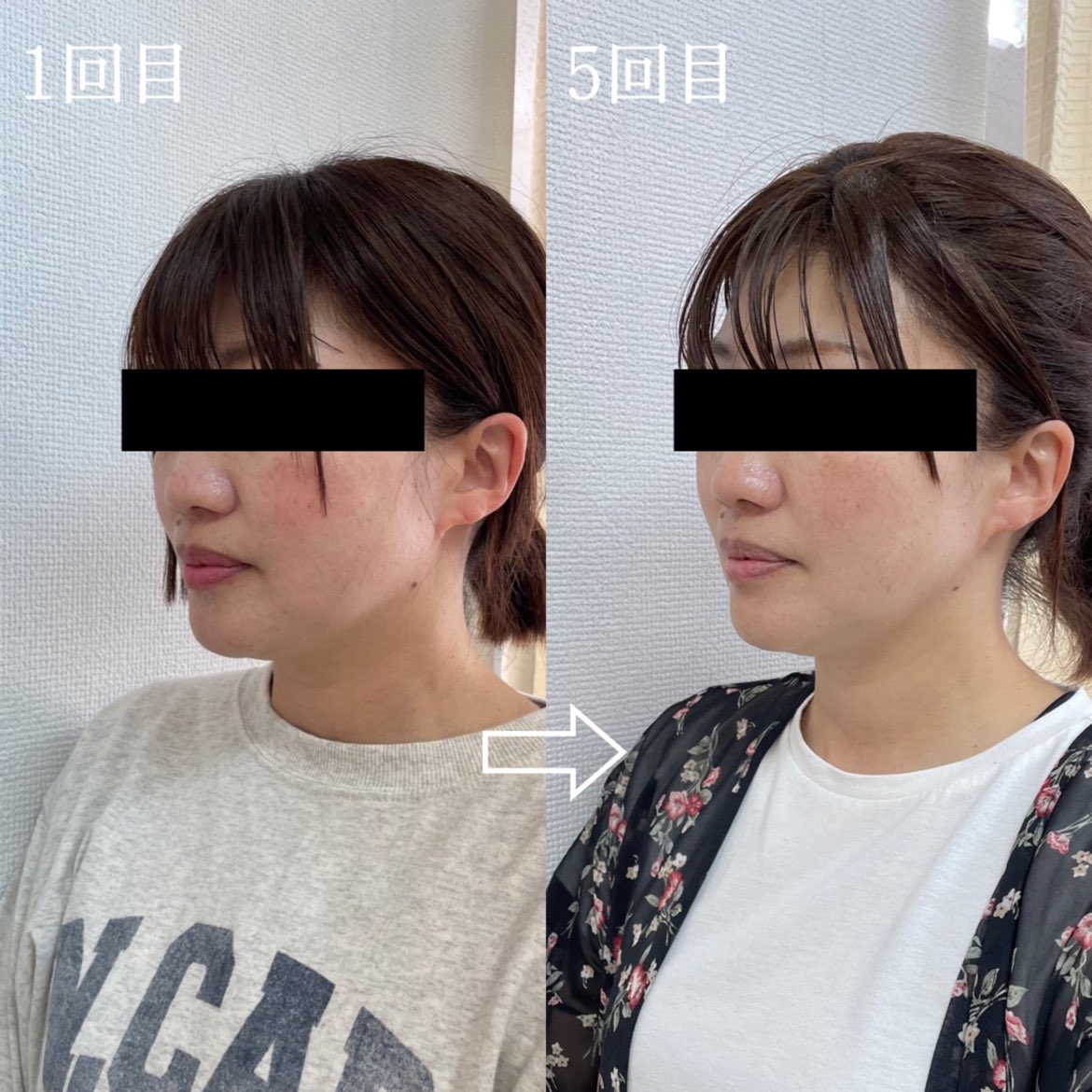 鳥取/エステ/エステサロン/ハイフ/HIFU
痩せ/痩身/むくみ/リフトアップ
部分痩せ/鳥取県/鳥取市
