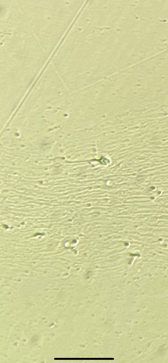 dromerfarukk's tweet photo. 2,5 yıllık bir özlemin sonuç fotoğrafı bu.
Non-obstruktif Azospermi.
Tedavi sonrası yeni sperm çıkışı hem ailenin hem de bizim yüzümüzü güldürdü.  
O sevinci aile ile birlikte yaşamak çok güzel… https://t.co/N7QCG7y6sJ