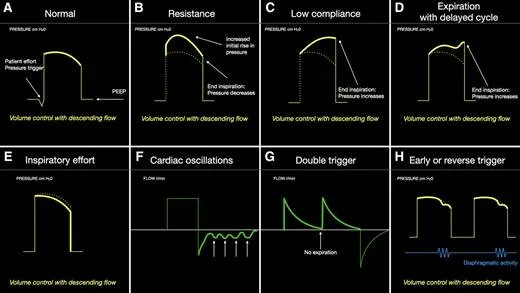 A nice review on interpretation of ventilator waveforms to diagnose pathologies buff.ly/3HHkM25 <a href="/_Anesthesiology/">Anesthesiology Journals</a> <a href="/vmoitra/">Vivek Moitra, MD</a>