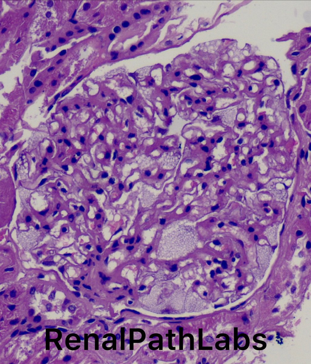 RenalPathLabs's tweet photo. Foamy Friday! What comes to your mind after looking at this glom?? 47 female, DIF-negative
D/D? Available investigative workup? Cost?Management?Prognosis?
#RareRenalCases
@RenalPathLabs @AskRenalPath @askrenal #RenalPathologySociety #ISRTP https://t.co/QLQX4DznkJ