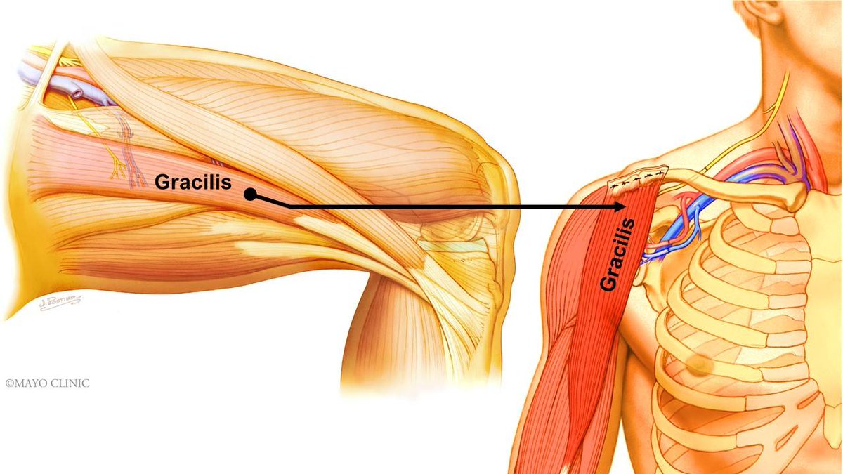 MayoClinic's tweet photo. Researchers and collaborators developed a way to collect data on human muscle during surgery without putting patients at risk or lengthening surgery time. This data improves computational models, enhancing the skill and experience of orthopedic surgeons: https://t.co/esEJpdCMFS https://t.co/PILbzYgF44