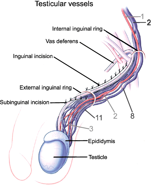 Bismillaah...
Di jum'at malam ini sy akan cerita tentang torsio testis. Yaitu puntiran funiculus spe...