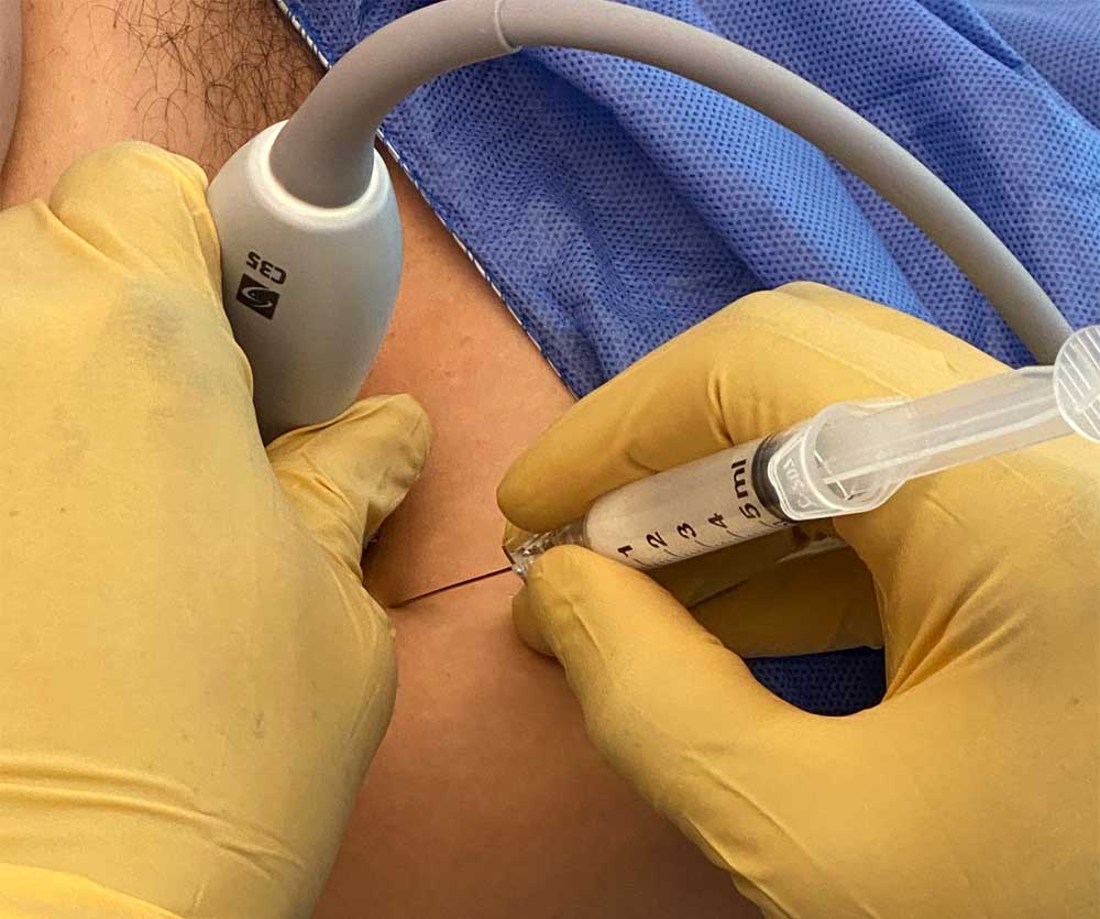 bennwachukwumd's tweet photo. How long does it take for a #hipinjection to work?
On average, ultrasound-guided hip injections can take from 2 to 7 days before the pain noticeably subsides. https://t.co/bZDq3RoDno #educathepatient #hippain #hipinjury https://t.co/L8hmLXqqbj