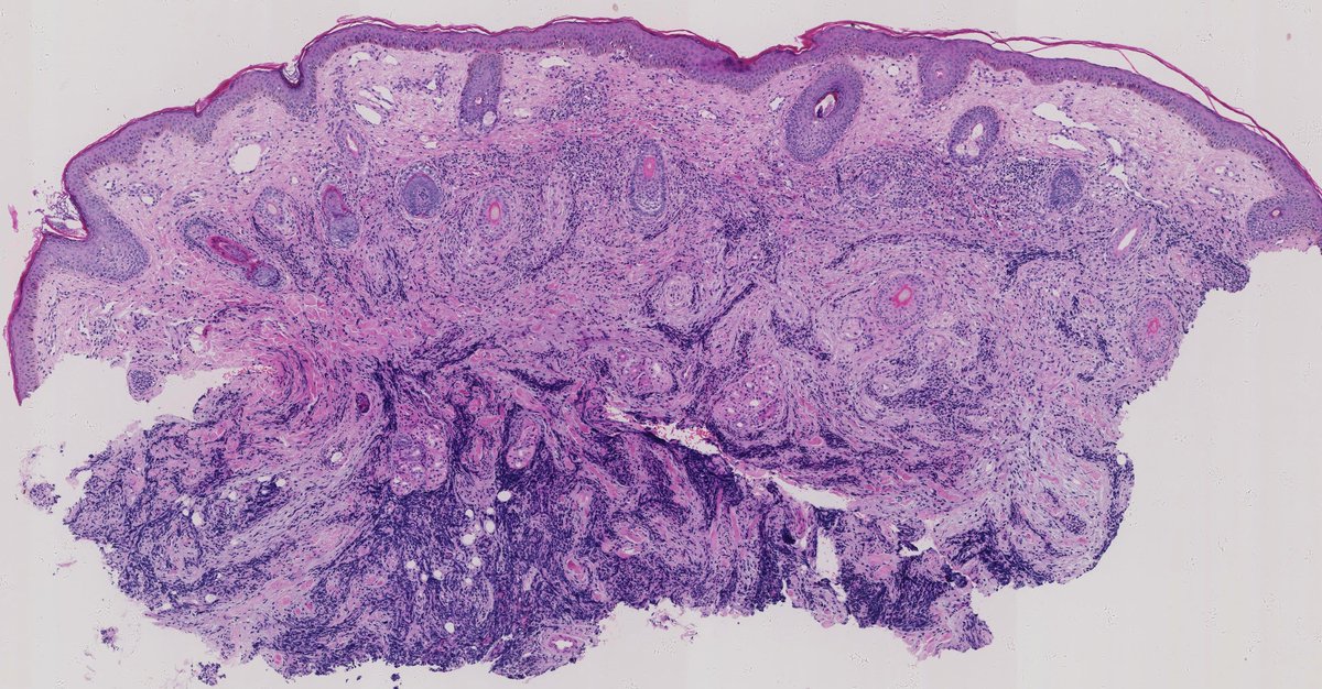 Henry YANG (@henryy_md) on Twitter photo Happy Friday.
#dermpath
<a href="/AlomariDermpath/">Ahmed Alomari, MD</a> <a href="/SGottesmanMD/">Silvija Gottesman MD</a> <a href="/TBrennster/">Thomas Brenn</a> <a href="/JLHornick/">Jason L. Hornick, M.D., Ph.D.</a> <a href="/mccalmo/">Tim McCalmont</a> <a href="/david_terrano/">David Terrano</a> <a href="/DiegoMoralesN/">Diego Morales, MD</a> <a href="/MarcelaSaebL/">Marcelasaeblima.</a> <a href="/Dermpathl/">Dermpath-L</a>
digital slide---kikoxp.com/posts/12741 Happy Friday.
#dermpath
<a href="/AlomariDermpath/">Ahmed Alomari, MD</a> <a href="/SGottesmanMD/">Silvija Gottesman MD</a> <a href="/TBrennster/">Thomas Brenn</a> <a href="/JLHornick/">Jason L. Hornick, M.D., Ph.D.</a> <a href="/mccalmo/">Tim McCalmont</a> <a href="/david_terrano/">David Terrano</a> <a href="/DiegoMoralesN/">Diego Morales, MD</a> <a href="/MarcelaSaebL/">Marcelasaeblima.</a> <a href="/Dermpathl/">Dermpath-L</a>
digital slide---kikoxp.com/posts/12741