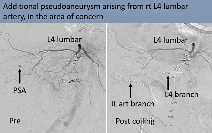 Rakesh Varma (@rakeshkvarma) on Twitter photo Clinical Pearls in IR 16:
<a href="/uab_ir/">UAB IR</a> we 'Always evaluate the AREA OF INTEREST and not just the artery of concern on imaging'
<a href="/SIRspecialists/">Society of Interventional Radiology</a> <a href="/SIRRFS/">SIR RFS</a> <a href="/SIR_ECS/">SIR ECS</a> <a href="/ISVIRIndia/">ISVIR India</a> #irad #radres Clinical Pearls in IR 16:
<a href="/uab_ir/">UAB IR</a> we 'Always evaluate the AREA OF INTEREST and not just the artery of concern on imaging'
<a href="/SIRspecialists/">Society of Interventional Radiology</a> <a href="/SIRRFS/">SIR RFS</a> <a href="/SIR_ECS/">SIR ECS</a> <a href="/ISVIRIndia/">ISVIR India</a> #irad #radres