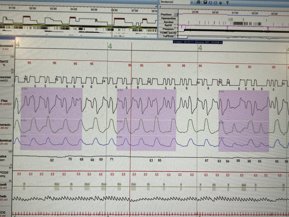 And many discussions to conclude…autotriggerings …not uncoupling neither reverse triggering because the first big cycles are not controlled!!!
