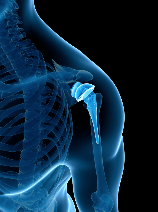 How is #ShoulderReplacement Surgery Performed?

AKA shoulder arthroplasty, this has come a long way in recent years and many patients are able to sustain normal lives following the procedure. Dr. Padalecki shares his expertise on the topic: medilink.us/hpdf #orthotwitter