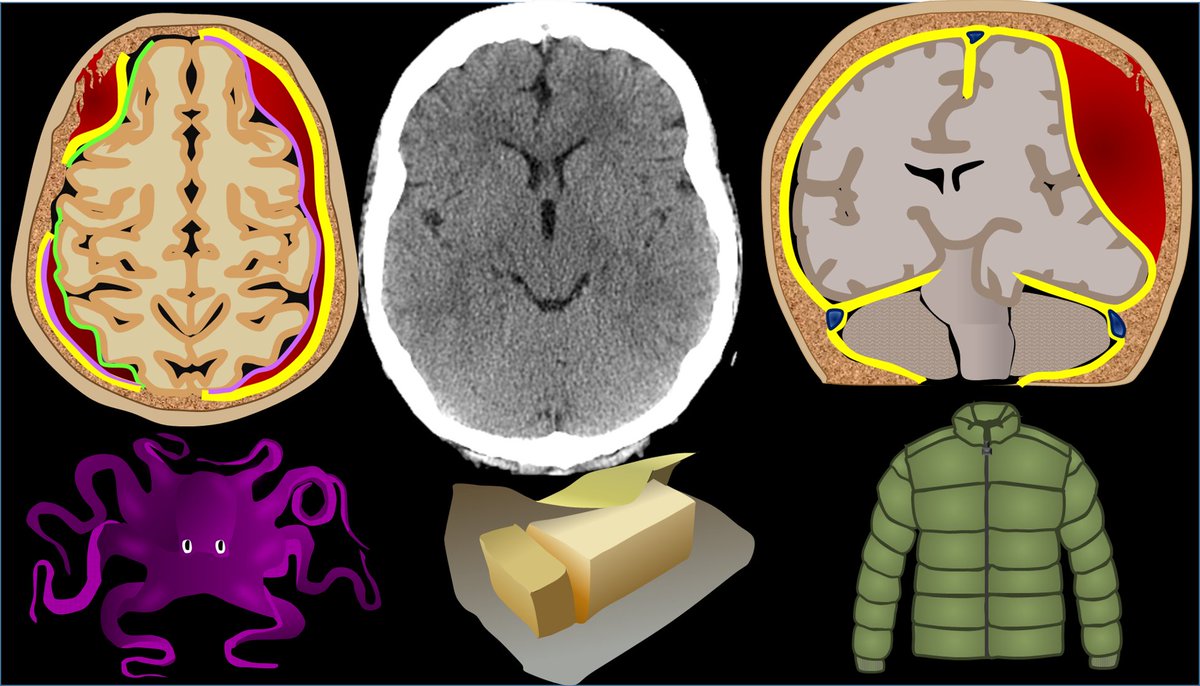 1/Radiologist not answering the phone?Just want a quick read on that stat head CT? Here's a little help on how to do it yourself w/a #tweetorial on how to read a head CT! #medtwitter #FOAMed #FOAMrad #medstudenttwitter #medstudent #neurorad #radres @medtweetorials #neurosurgery