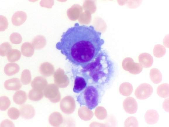 VandaTorousMD's tweet photo. Met lung AdenoCA (top) vs normal CSF elements monocytes and lymphocyte
AdenoCAs in CSF will often appear singly rather than in clusters like other fluids& cytologically bland. Size is a helpful distinguishing feature from background elements
#FluidsFriday #Cytopath #PathTwitter https://t.co/bEYaY82tuG