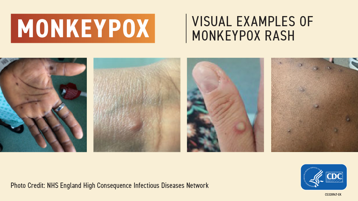 CDCgov's tweet photo. Clinicians: Remember that cases of monkeypox have been identified in the United States. Be alert for patients who have new or unexplained rashes. If you suspect monkeypox when treating patients, consult your local health department. Learn more: https://t.co/mYJfQIHCLq. https://t.co/8c0qrSqeDB