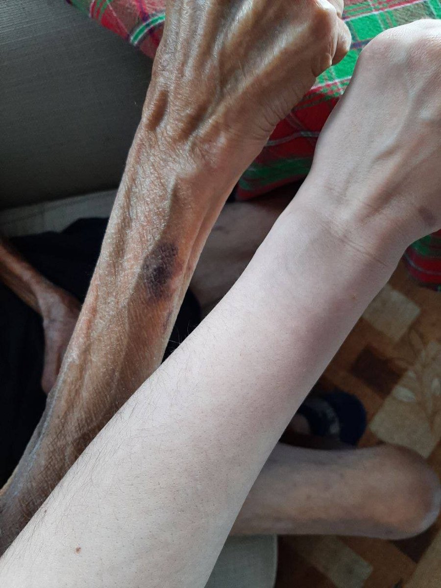 UA_struggle's tweet photo. The difference between the hand of a healthy person and a Ukrainian who is in Mariupol. A girl got her uncle out of the blockade. The Russians denied him food and medicine for months. He looks like a concentration camp prisoner and requires rehabilitation. https://t.co/xnj0jK0fPW