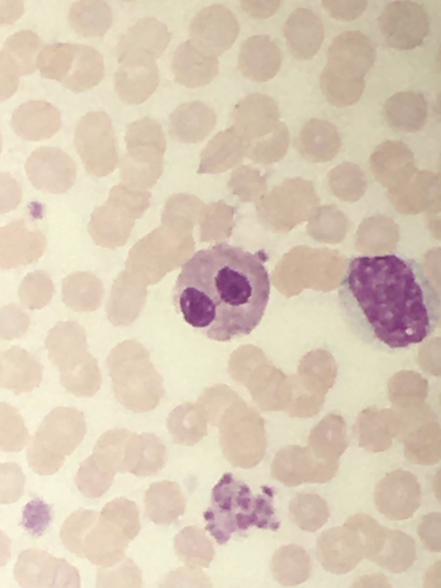 megothelioma's tweet photo. Pelger-Huet cells lookin like πππ
#Hemepath #PathTwitter #MSGPath https://t.co/QLADqx99PZ