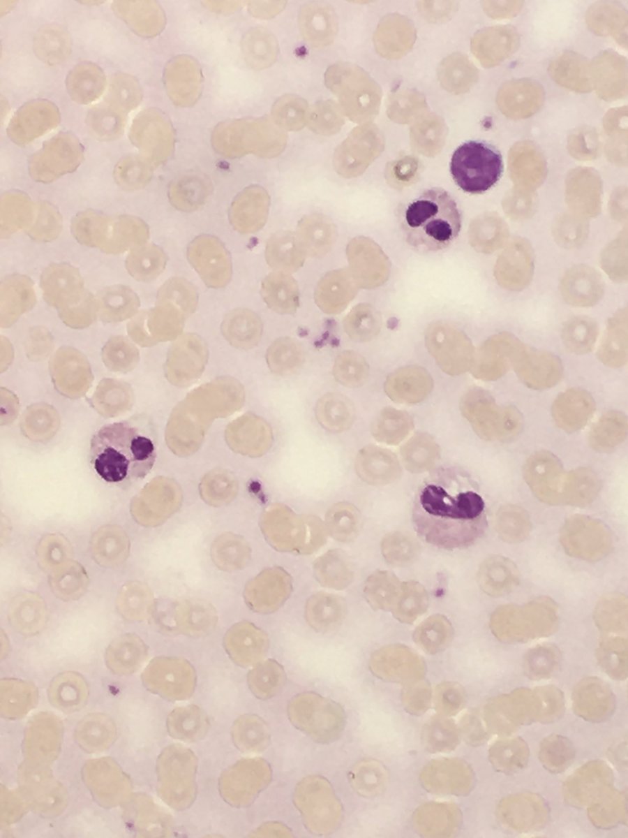 megothelioma's tweet photo. Pelger-Huet cells lookin like πππ
#Hemepath #PathTwitter #MSGPath https://t.co/QLADqx99PZ
