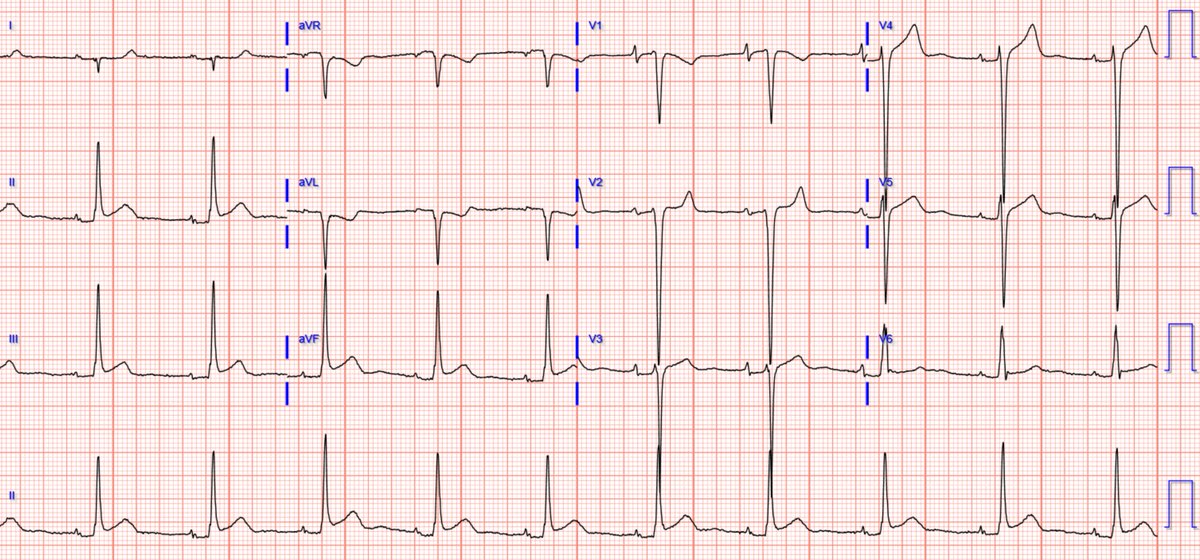 smithECGBlog's tweet photo. A man in his 30s with chest pain and a normal bedside echo, without wall motion abnormality. @PendellM 

https://t.co/CpAF7I0K3M https://t.co/rgsG3jT0xD