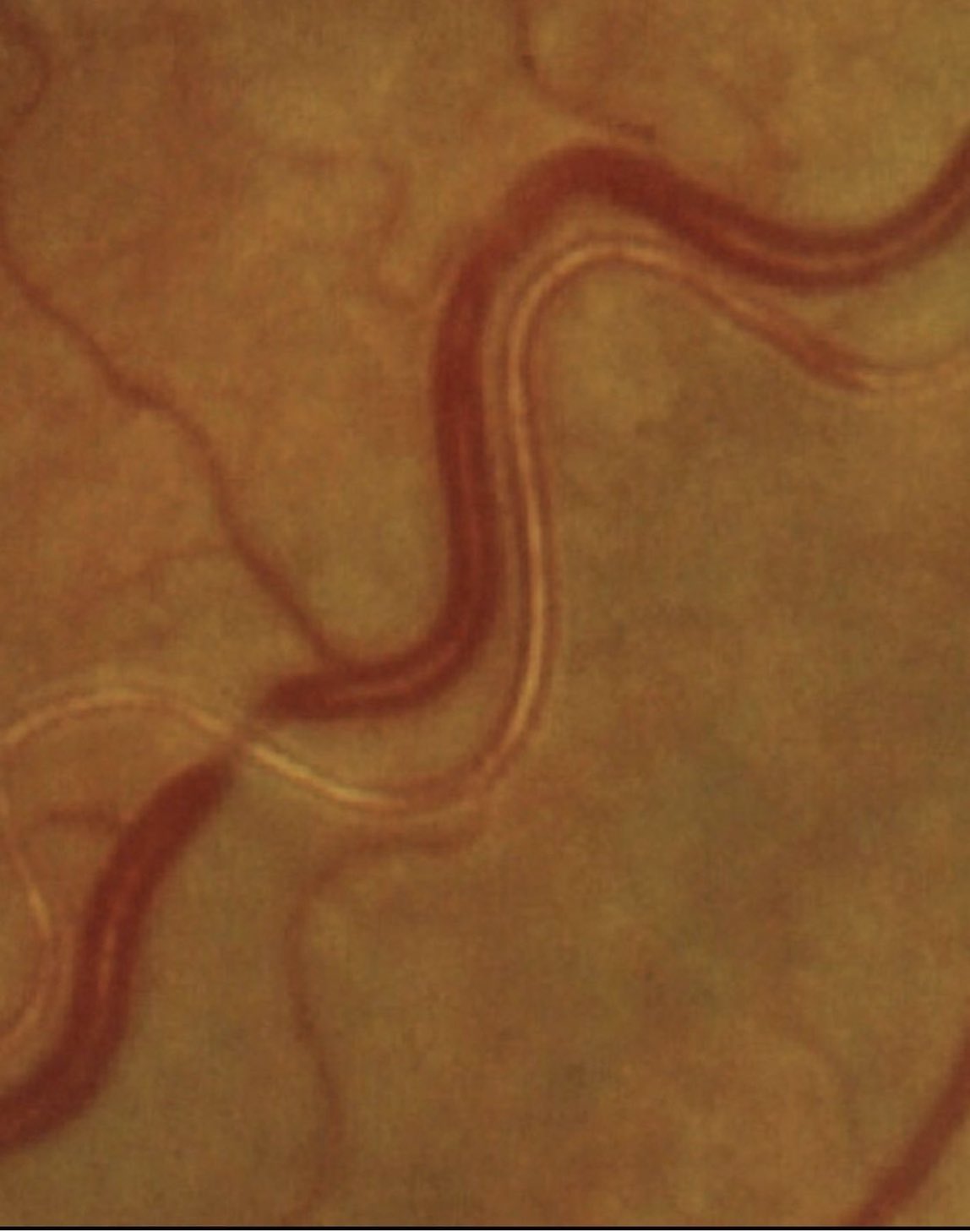 Hypertensive Retinopathy Silver Wiring