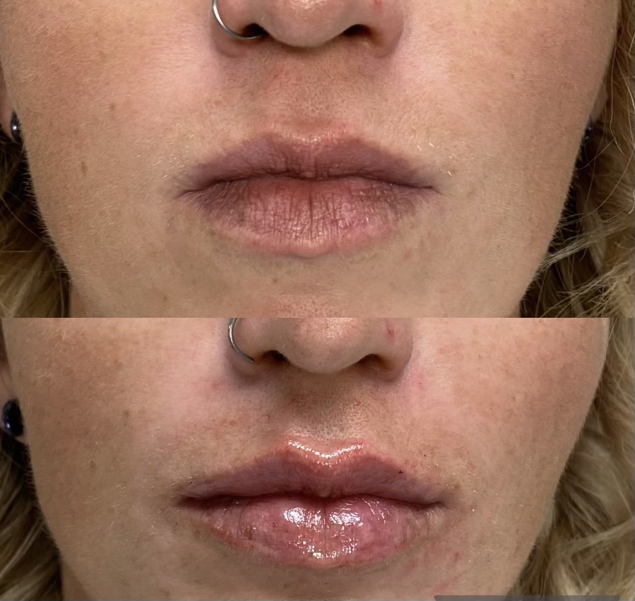 LSmedspa's tweet photo. When patients are so dang pretty, they make our job easy! All smiles because who wouldn't with these lips. 👏

Raise your hand if you want some! 🙋‍♀️

✨+ Don't forget to live confidently, wear sunscreen, and get all the filler! ✨ https://t.co/lE04wJ6V0e