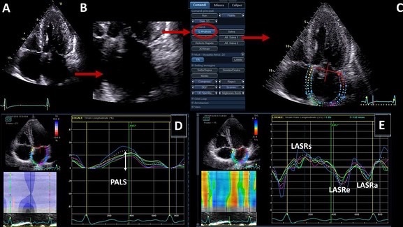 italian_cot's tweet photo. 🧠🫀 Continua la nostra rubrica “ICOT topic of the week” 🧠🫀 

💡Early reduction of left atrial function predicts adverse clinical outcomes in patients with severe aortic stenosis undergoing transcatheter aortic valve replacement. #itcardiology
 
Link: https://t.co/DC72R6S3n0 https://t.co/ajaGsKG8fk