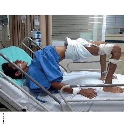 ng7ahmada's tweet image. (⛑️) Ce patient est atteint de tétanos ! 🦠
➡️ L'un des symptômes de cette condition est l'opisthotonos. 👨‍⚕️
L'opisthotonos est un état dans lequel une personne tient son corps dans une position anormale.