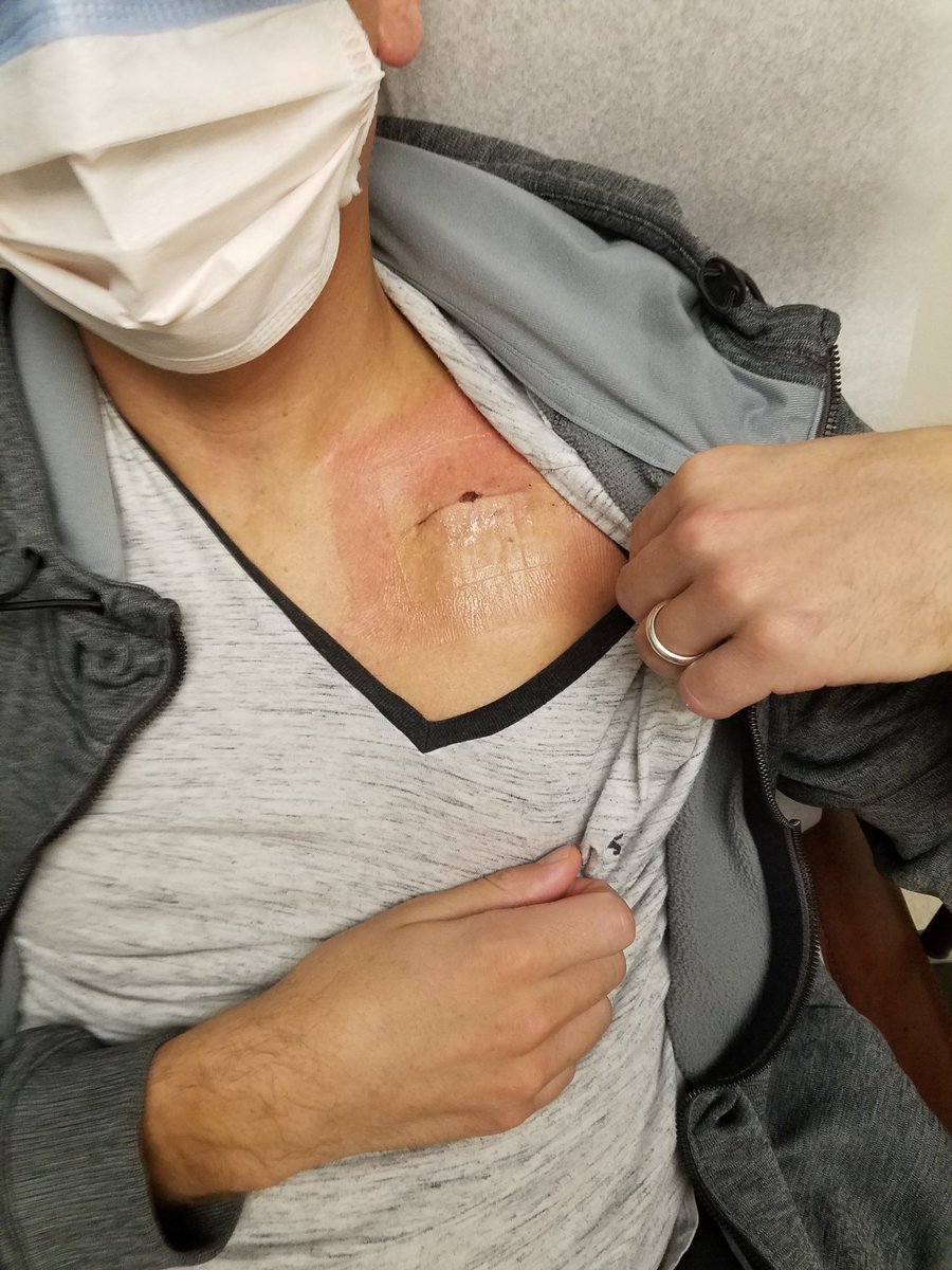 c_maz10's tweet image. #CanWeTalkAboutIt
10/21 got my 2nd Pfizer 💉, 15 hours later lost consciousness 3x, several cardiac arrests, received CPR numerous times &amp;amp; shocked 20+ times over 48 hours. ICU &amp;amp; on ventilator for 18 days, left with an ICD in my chest. #VaccineInjured, #VaccineDisability  is real