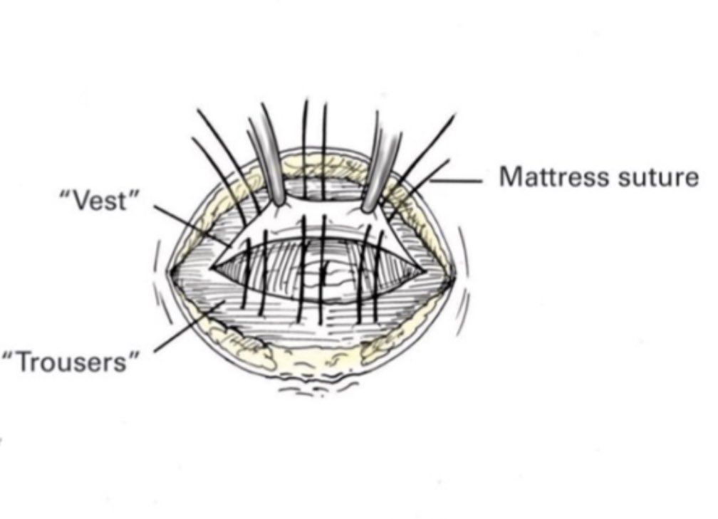 Details more than 56 pants over vest suture technique latest in.eteachers