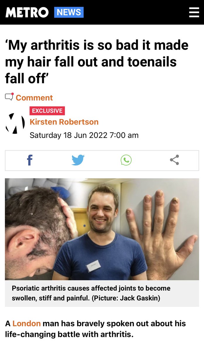 Arthritis_ACTN's tweet photo. Our @YouGov report has featured in @MetroUK today! The powerful article highlights the true impact of living with #arthritis. Thanks to our Member Jack Gaskin for sharing his story of how #psoriaticarthritis has directly affected his #work and #health: https://t.co/n0ixV8qJVE https://t.co/JcZFRgl9av