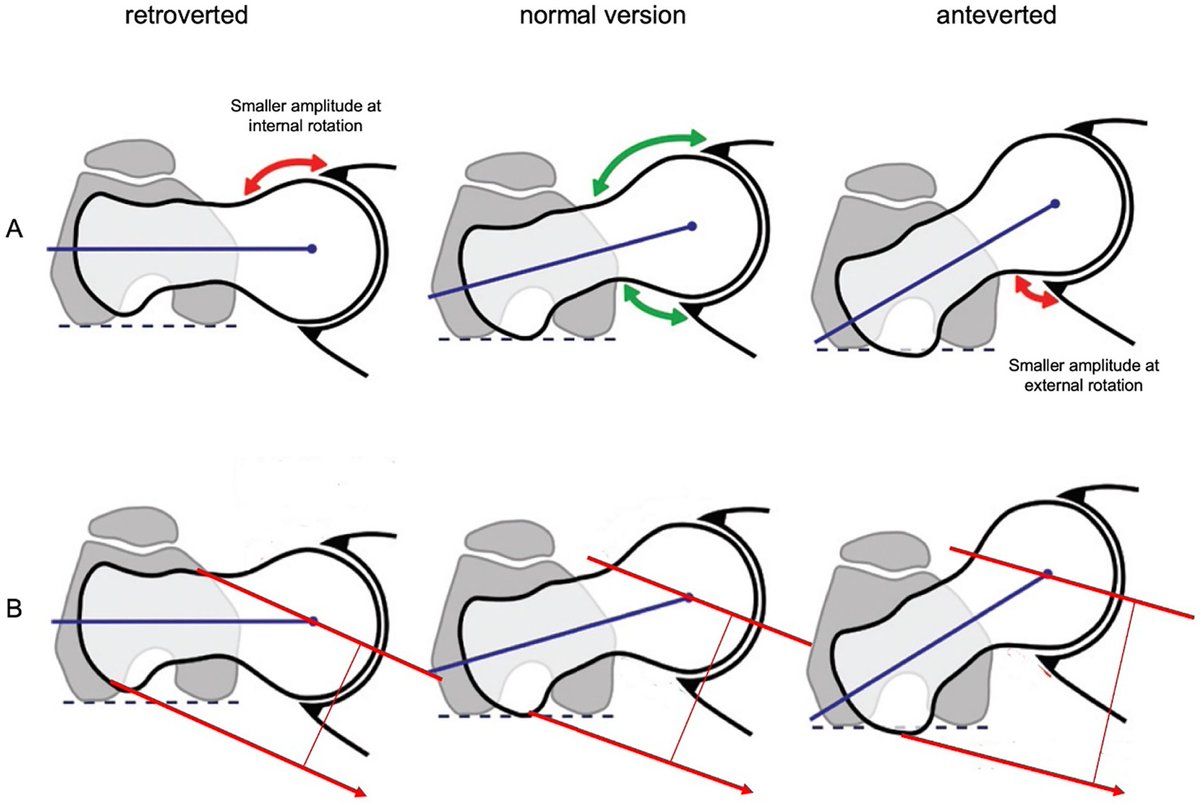PhysioMeScience's tweet image. Do femoral version abnormalities play a role in hip function of patients with hip pain?

👀👀👇👇

sciencedirect.com/science/articl…