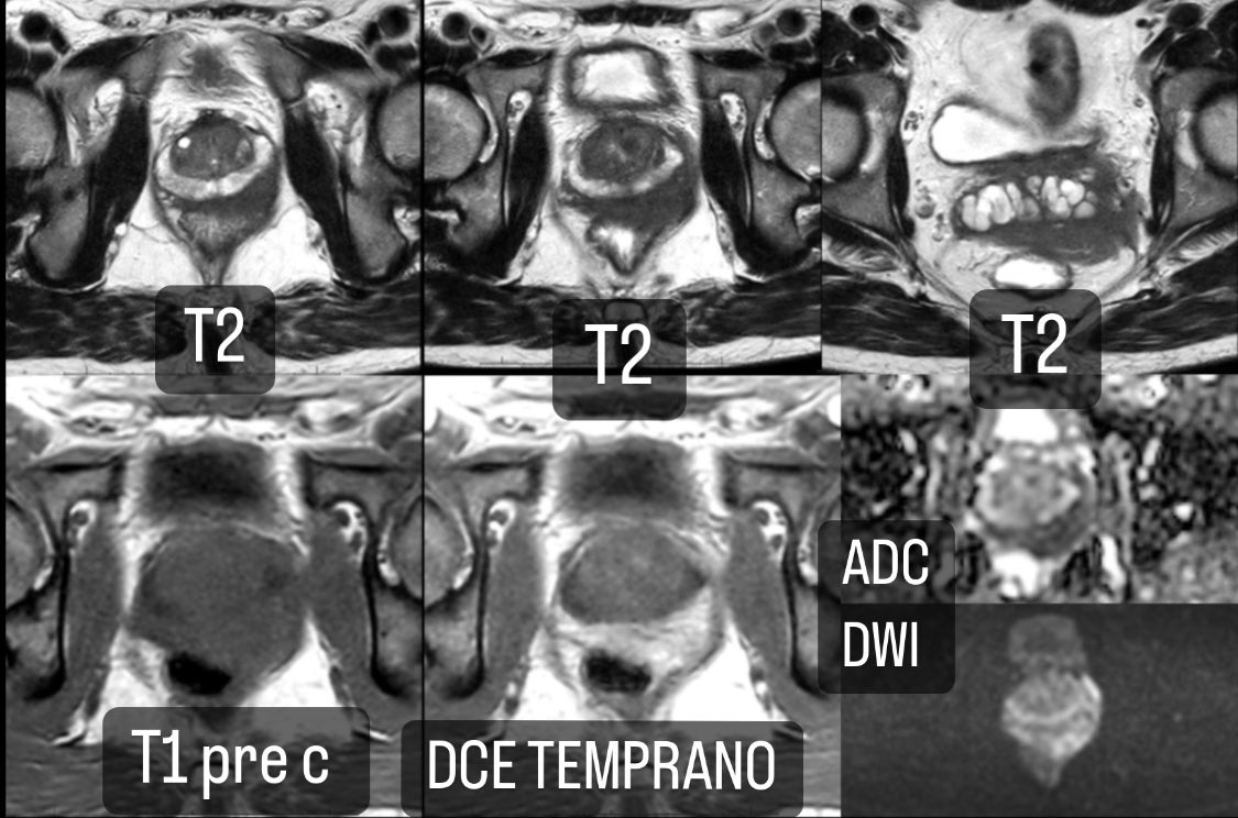 CASO VISULALIZADO DURANTE MI ESTANCIA FORMATIVA EN LILLE, FRANCIA. 

La prostata y VS. están rodeadas de un tejido hipointenso en T2 (flechas) con intenso realce precoz post en DCE y restricción en DWI. 
La histologia reveló #linfoma. 
#prostate 

<a href="/voxelmator/">Philippe PUECH</a> <a href="/ARGUL_research/">A.R.G.U.L</a>
