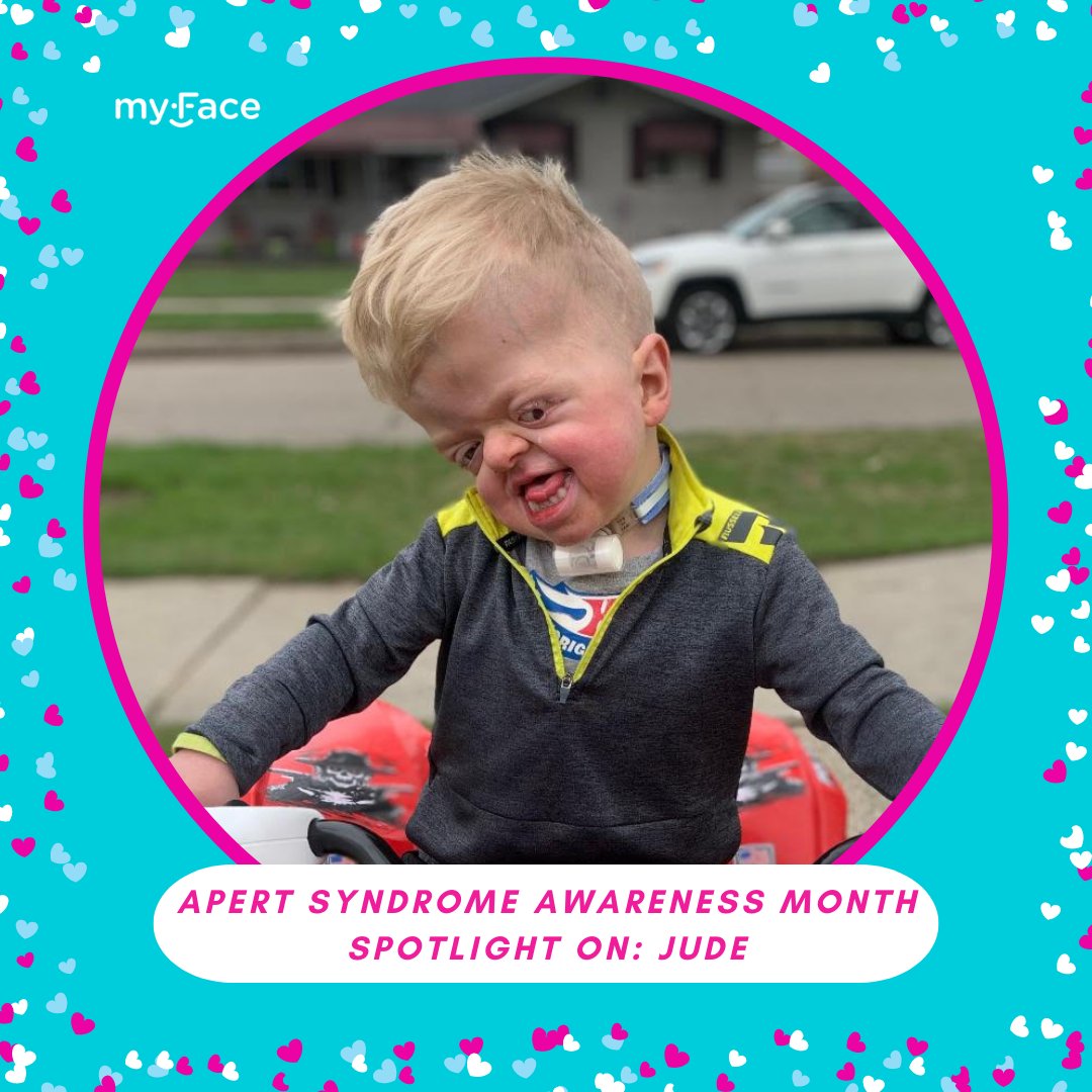 myfaceorg's tweet image. Stephanie - mom of sweet little Jude says: “Stare less. Love more. Just say hi. Teach your kids about #FacialDifferences &amp;amp; differences in general. God created this beautiful being who lights up my life every day!” 

#ApertSyndromeAwarenessMonth