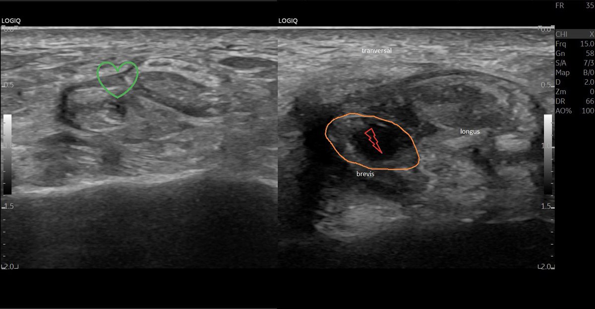 SportklinikBern's tweet photo. Chronic #partialrupture of the #peroneusbrevis with #tendinopathy of the #peroneuslongus after multiple #anklesprain - #mskus #pocus #pocushub #GElogiqE10r3 - thanks to the software update with a stunning clear view #gehealthcare https://t.co/3pDhMBMKX1