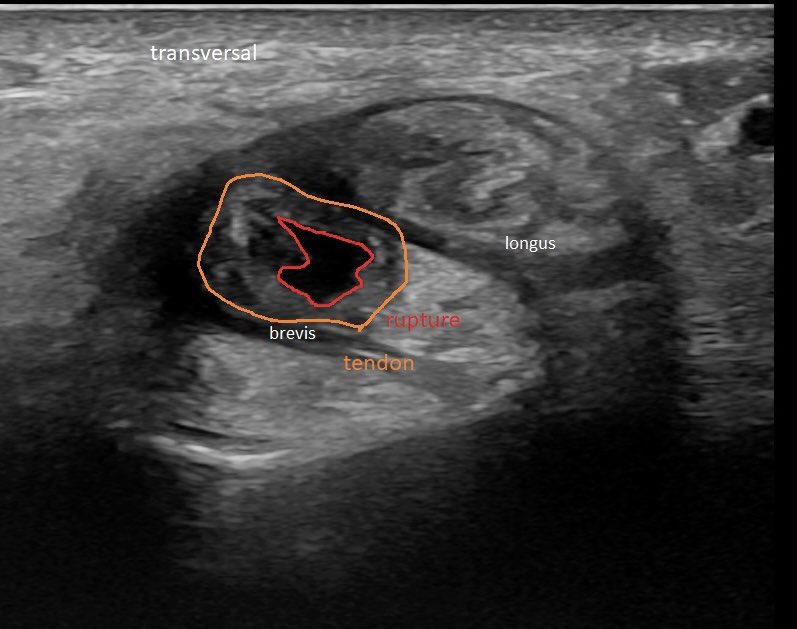 SportklinikBern's tweet photo. Chronic #partialrupture of the #peroneusbrevis with #tendinopathy of the #peroneuslongus after multiple #anklesprain - #mskus #pocus #pocushub #GElogiqE10r3 - thanks to the software update with a stunning clear view #gehealthcare https://t.co/3pDhMBMKX1