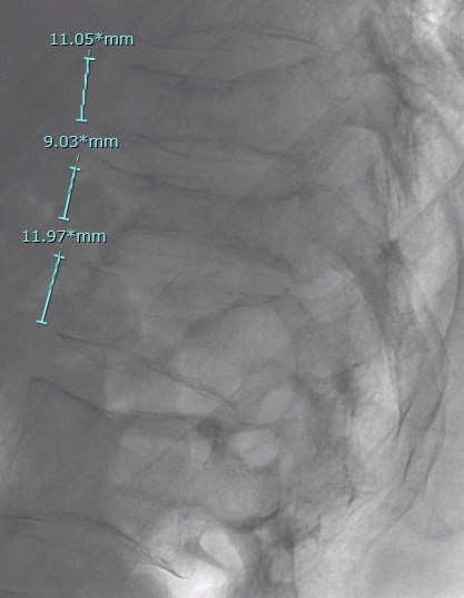 RaDPhung's tweet photo. T11-L1 acute compression fractures in a young myeloma patient treated with #SpineJack to great effect!  Height restoration at the thoracolumbar junction is key for biomechanics. @USCneurorads @RobJones_31 @JAcharya4 @TheStrykerIVS https://t.co/VOdsO1Anrs