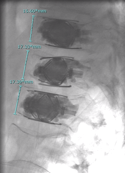 RaDPhung's tweet photo. T11-L1 acute compression fractures in a young myeloma patient treated with #SpineJack to great effect!  Height restoration at the thoracolumbar junction is key for biomechanics. @USCneurorads @RobJones_31 @JAcharya4 @TheStrykerIVS https://t.co/VOdsO1Anrs