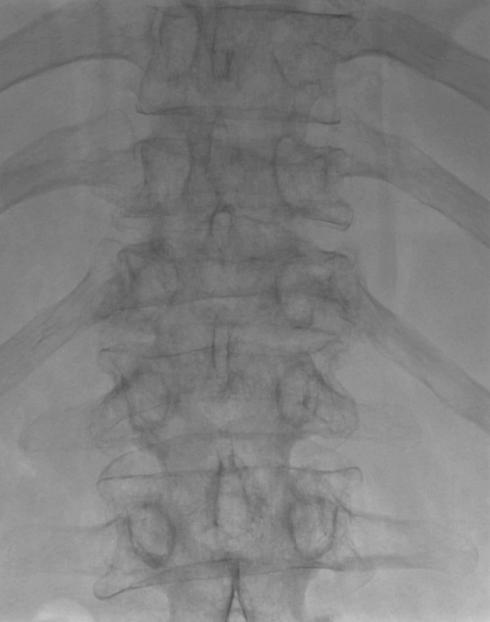 RaDPhung's tweet photo. T11-L1 acute compression fractures in a young myeloma patient treated with #SpineJack to great effect!  Height restoration at the thoracolumbar junction is key for biomechanics. @USCneurorads @RobJones_31 @JAcharya4 @TheStrykerIVS https://t.co/VOdsO1Anrs