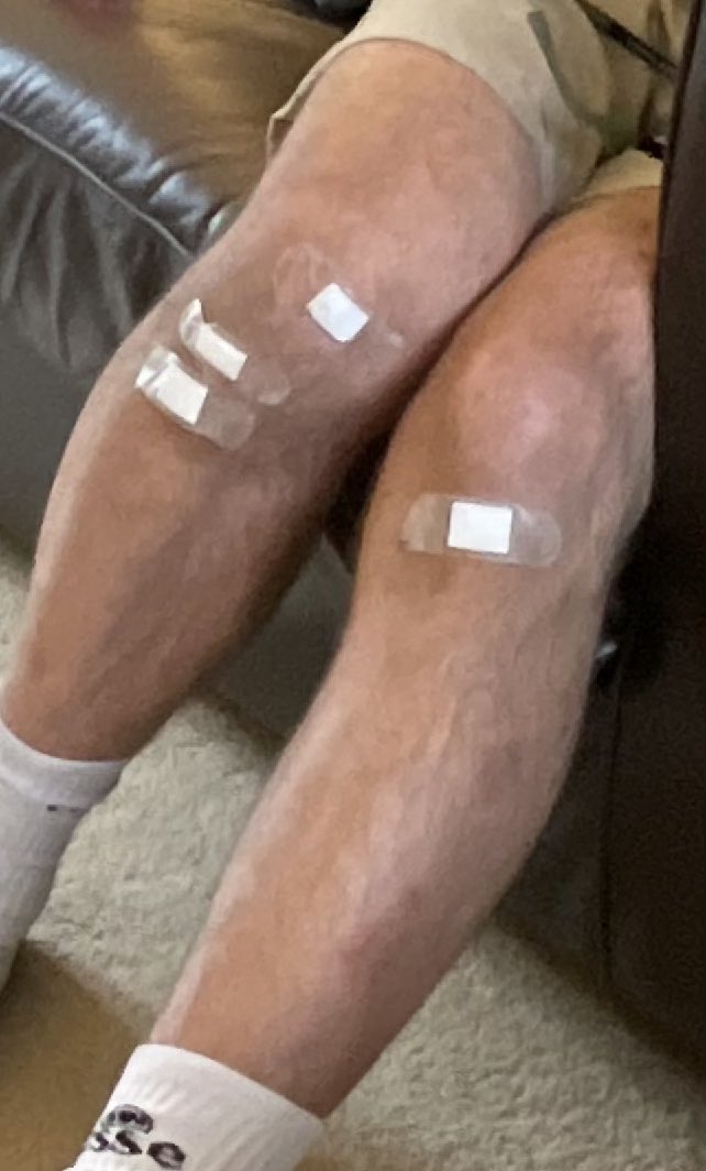 KKessack's tweet photo. When a 2 year old gets hold of a box of plasters, and a willing grandad #apprenticenurse https://t.co/Srd6Zms4rq