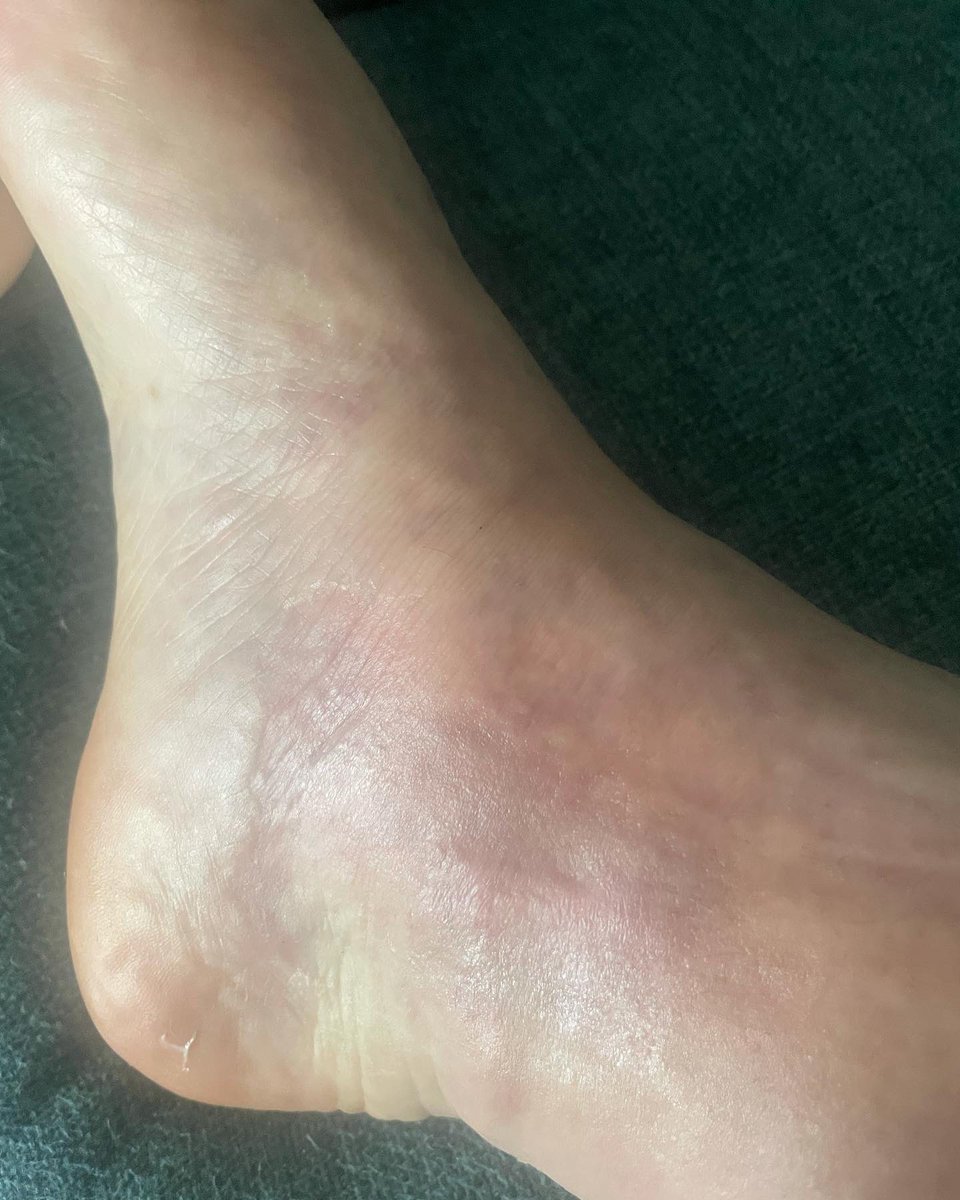 ndeanstockport's tweet photo. Foot update! #evla operation was on Weds. Last pic was last weekend 🤢Today I walked 15 minutes for a coffee (admitted I cried coming home) this is the longest I’ve walked in months. Leg is still swollen but getting there #lymphedema #phlebitis #lipodermatosclerosis https://t.co/A2cgScmUKS