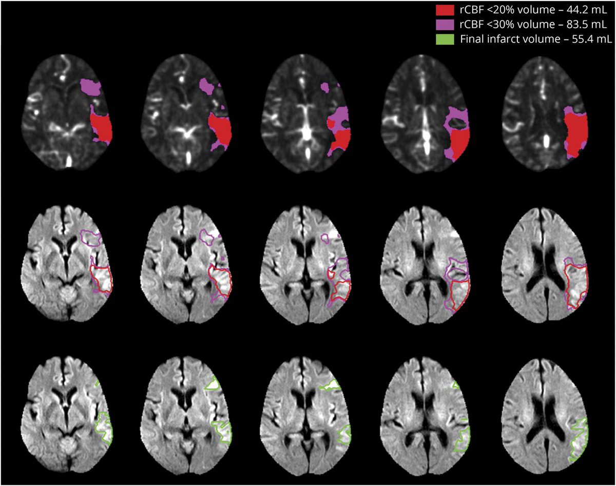 fgiloarrojo's tweet photo. "Accuracy of #CTPerfusion–Based Core Estimation of Follow-up Infarction". Use of #rCBF<20% threshold in patients presenting within 90 minutes eliminated all significant overestimation. Amrou Sarraj et al https://t.co/Pk1g0FSAcH https://t.co/j07SOvJxzX