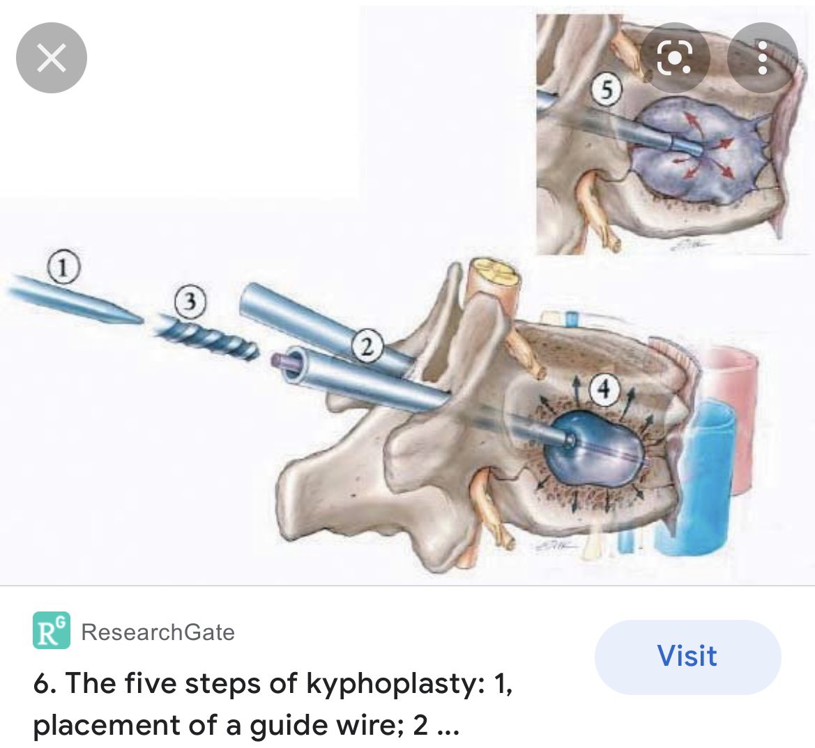 1) A 🧵 looking at Vertebral Compression Fractures (VCF). https://t.co/KB5hn5Ytp5