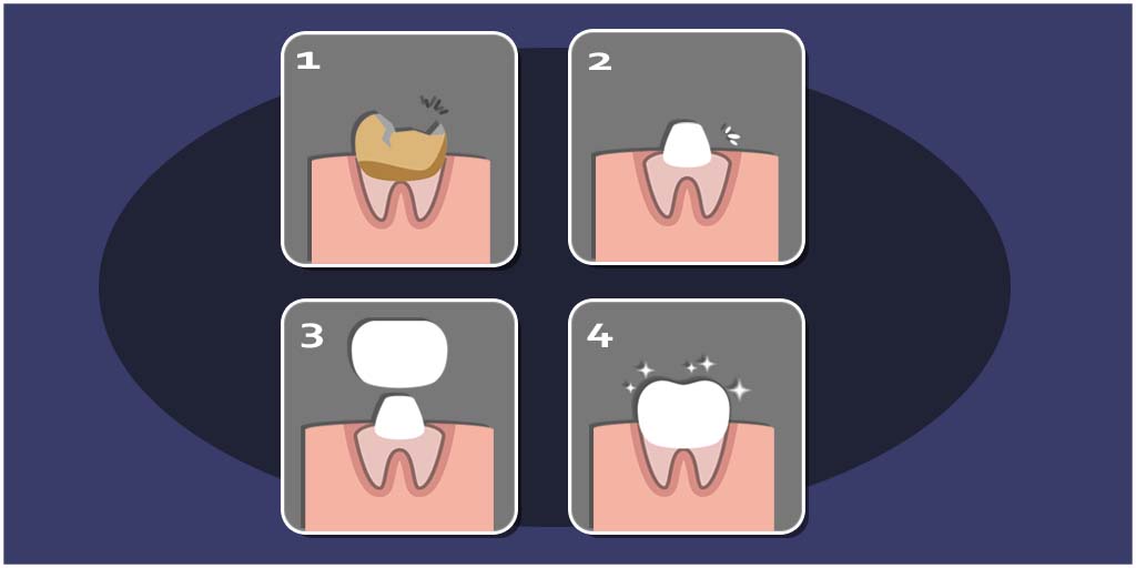 SandLakeDentist's tweet image. Don't let a decayed or damaged tooth go unnoticed. 🦷
Try our durable dental caps that snug-fit the affected tooth &amp;amp; look natural. #Caps #TeethCaps #DentalCaps #DentalCrowns #SmileEnhancement