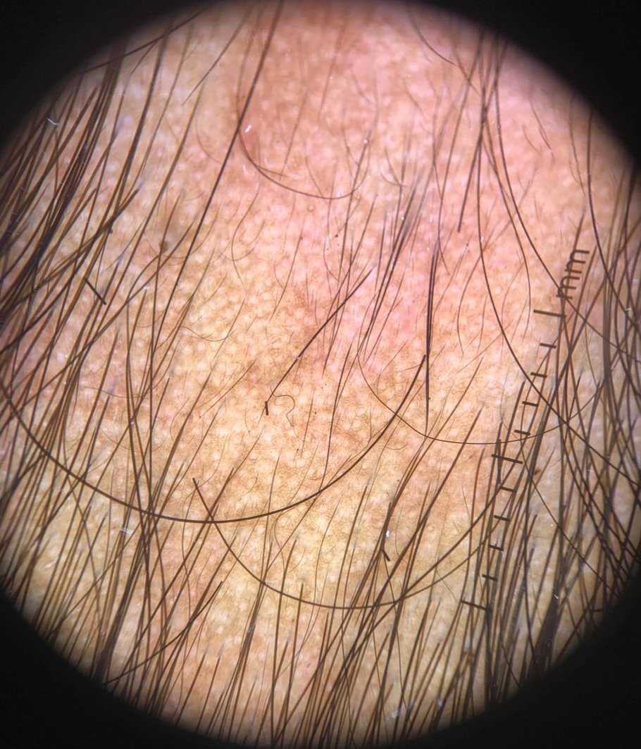 docpiyush's tweet photo. 15 M
Patchy alopecia since birth.
Not progressing.
Diagnosis and explanation?
#MedTwitter
#Dermatology
#DermDx
#Trichology
#Trichoscopy
#Alopecia https://t.co/4Dv3Cttp02