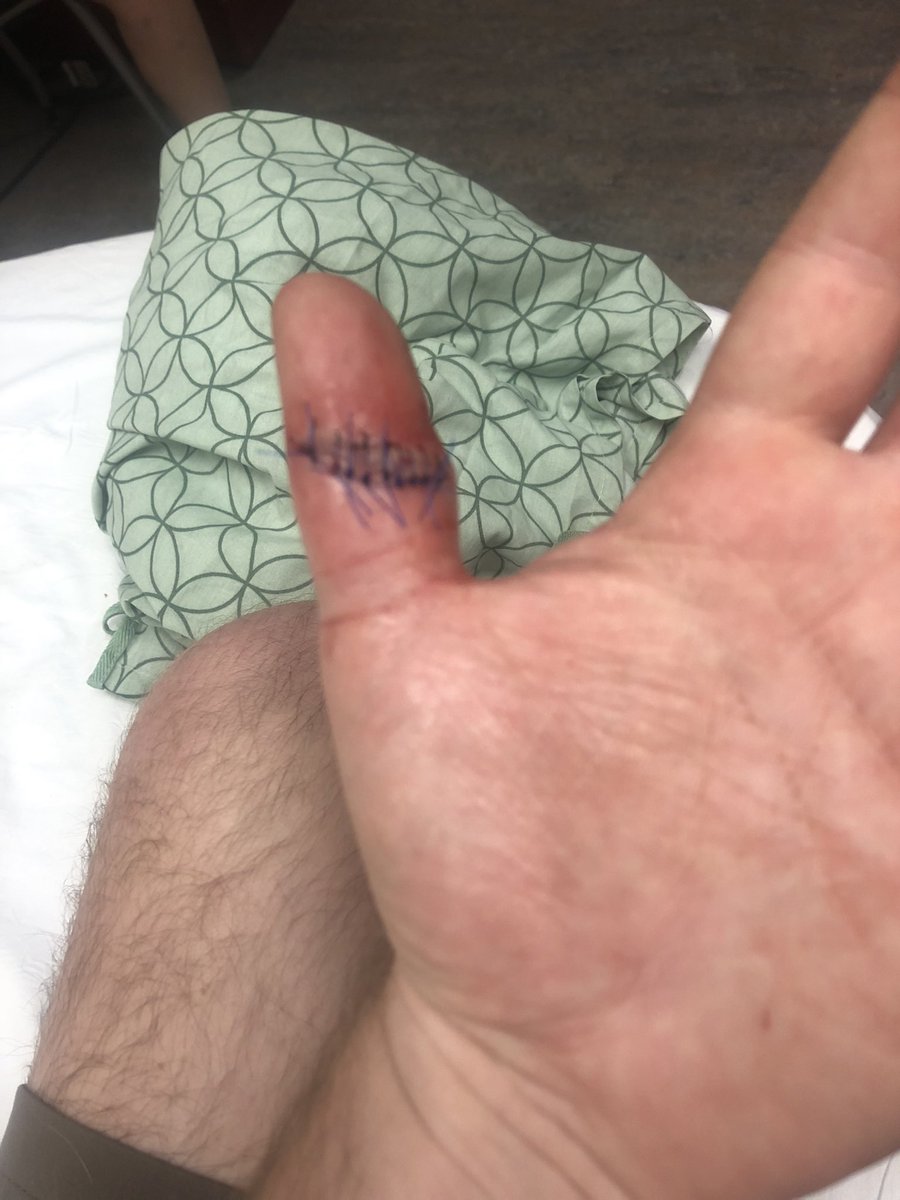 Everybody said, Ben, you're a woodworker, get the <a href="/SawStop/">sawstop</a>. But nobody said, Ben, you're a sub par griller, don't get a <a href="/WeberGrills/">Weber Grills</a> with a lid that can swing shut on your thumb. #woodworking #grilling